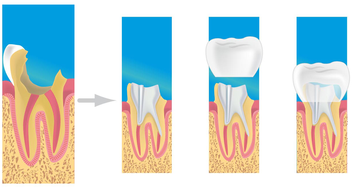 prothese dentaire corbeil essonnes